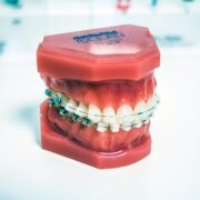 Transparent Teeth Braces