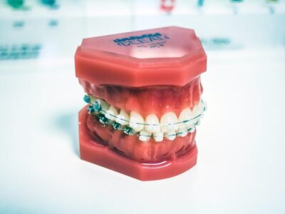 Transparent Teeth Braces