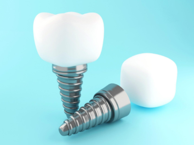 Front Dental Implant