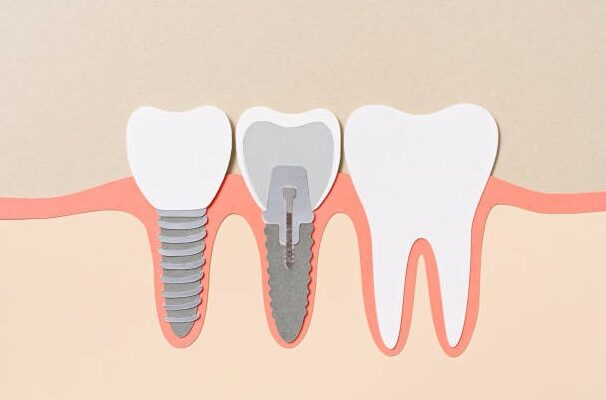 Dental Implants