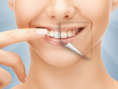 Dental Whitening