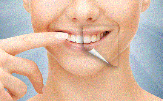 Dental Whitening